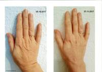 Skindream Kundenbild Wirkung Hände