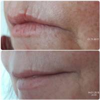 Skindream Kundenbild Wirkung Lippen