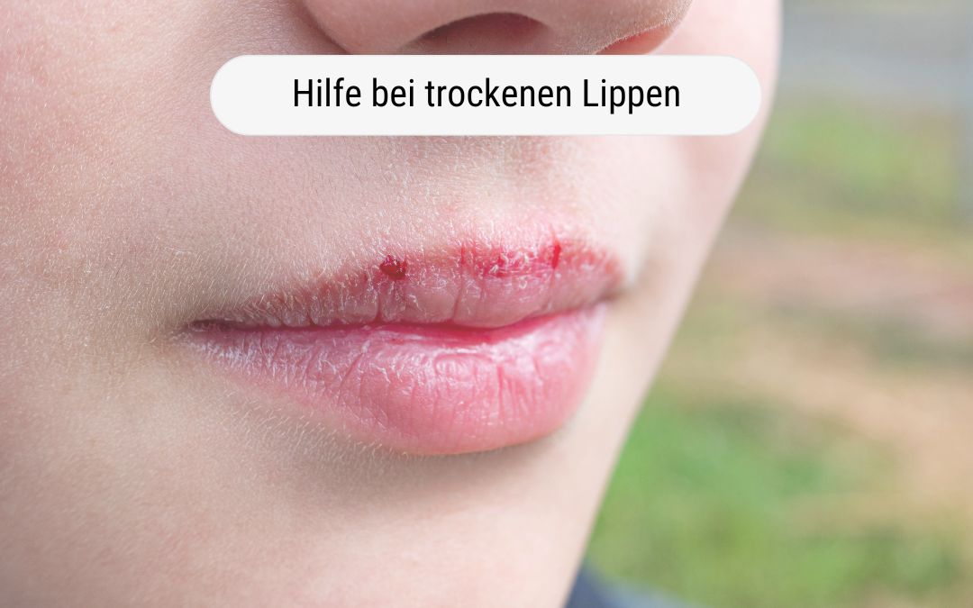 Lippen-SOS: Hilfe bei trockenen Lippen